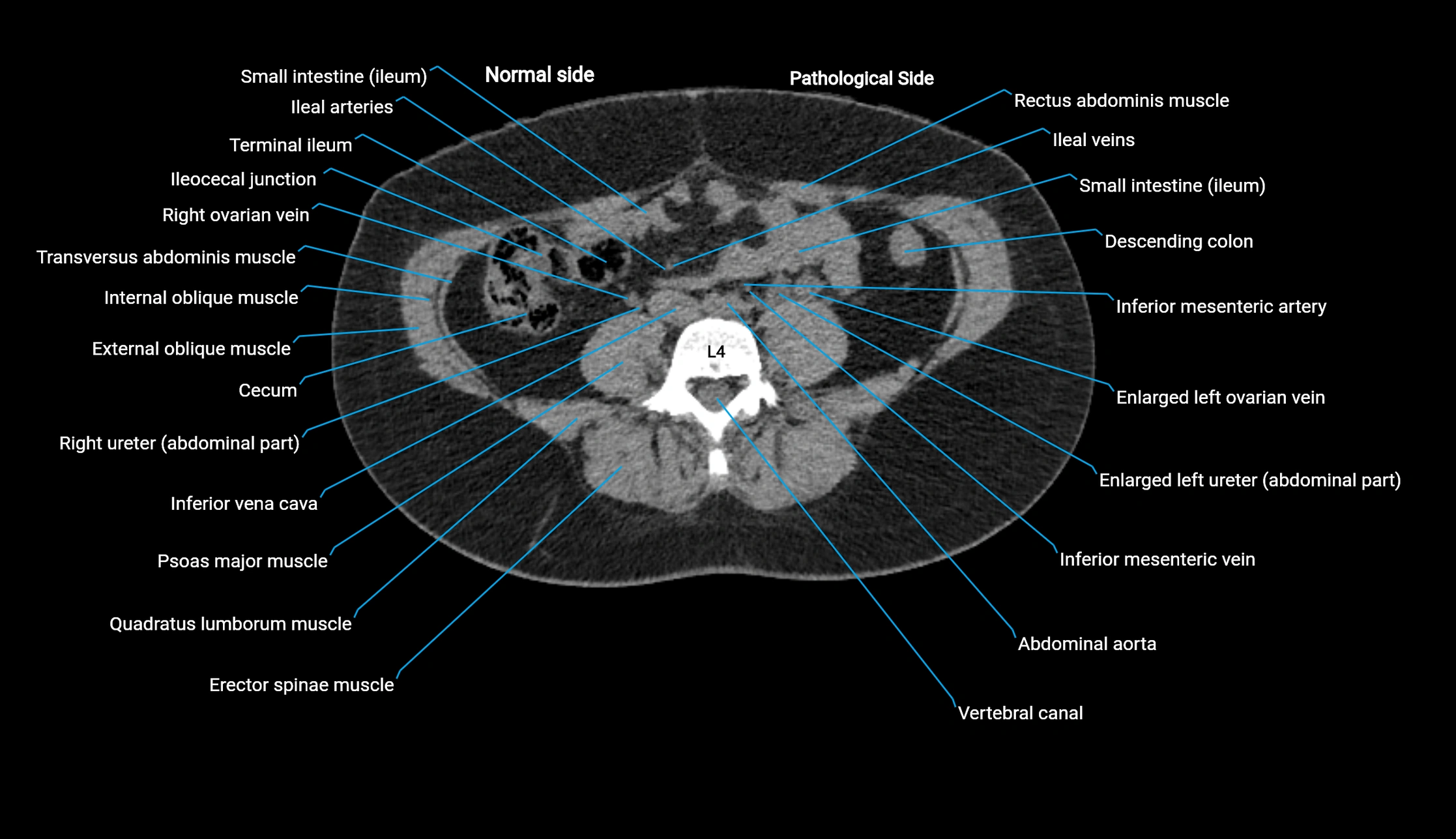 CT KUB axial cross sectional anatomy  radiology image -img-00201-00088.webp